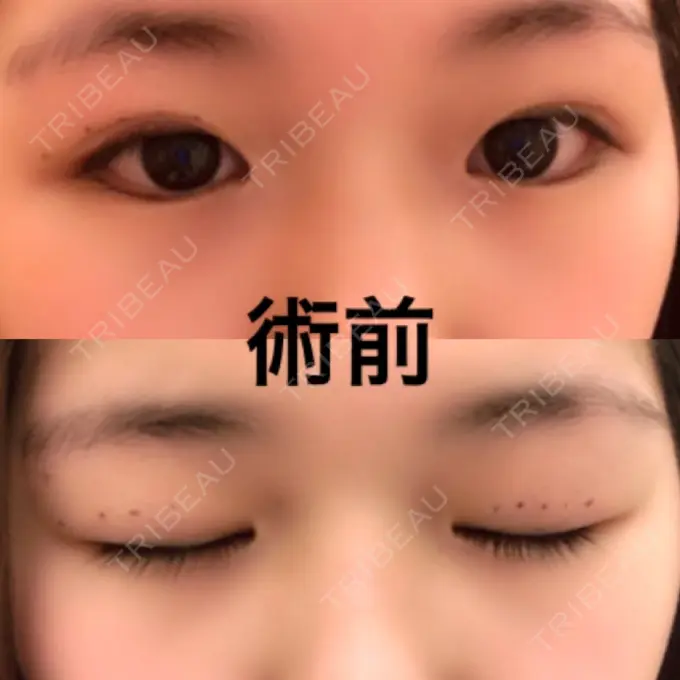 二重切開 品川スキンクリニック広島院 BEFORE メイン用