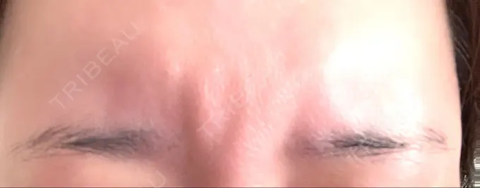 ボトックス（眉間） TCB東京中央美容外科 中野院 BEFORE メイン用