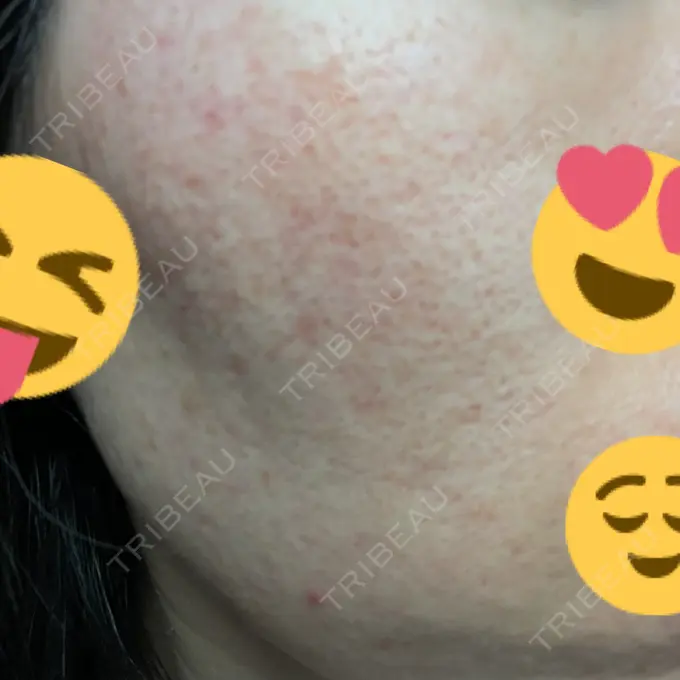 イオン導入 / ニードルRF（ポテンツァなど） オラクル美容皮膚科 名古屋院 BEFORE メイン用