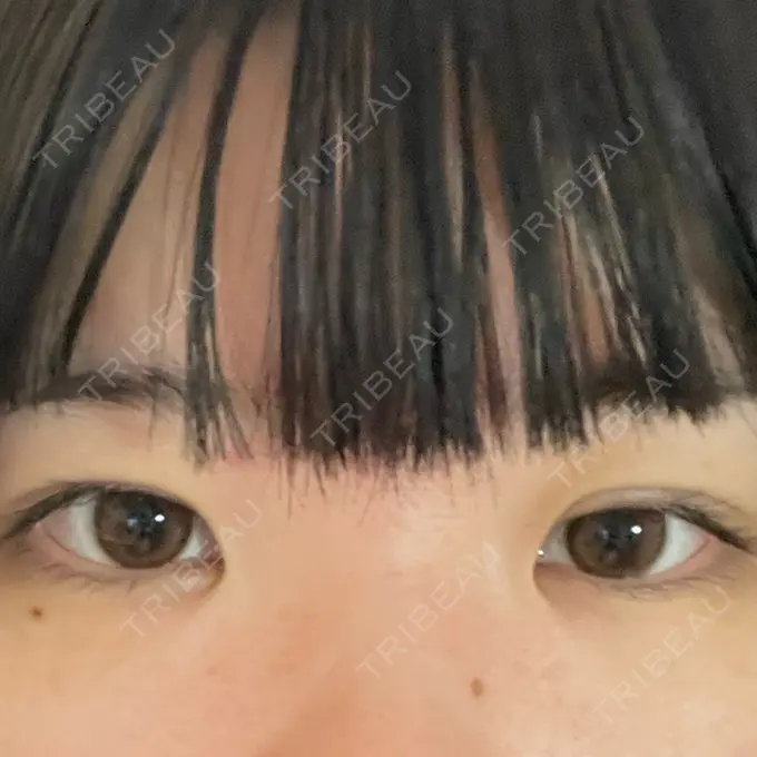 目頭切開 聖心美容クリニック 名古屋院 BEFORE メイン用