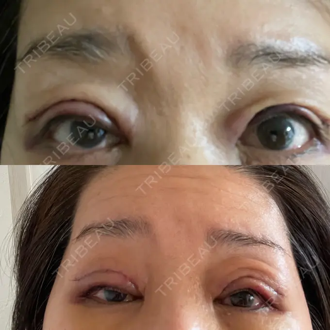 二重切開 / 眼瞼下垂（切開） / 上まぶたたるみ取り X CLINIC 大阪院 BEFORE メイン用
