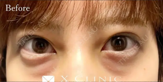 クマ治療 X CLINIC 福岡天神院 BEFORE メイン用