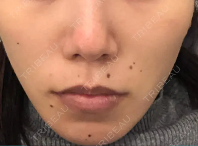 軟骨移植 / 骨切幅寄せ / ワシ鼻修正・ハンプ切除 / 鼻尖形成（非切開） 銀座マイアミ美容外科 BEFORE メイン用