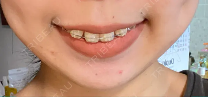 ボトックス（口角） Olino美容外科・美容皮膚科 BEFORE メイン用