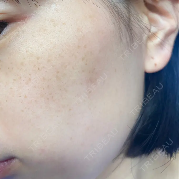 ピコレーザートーニング（美白・肝斑） まゆりなclinic 名古屋栄 BEFORE メイン用