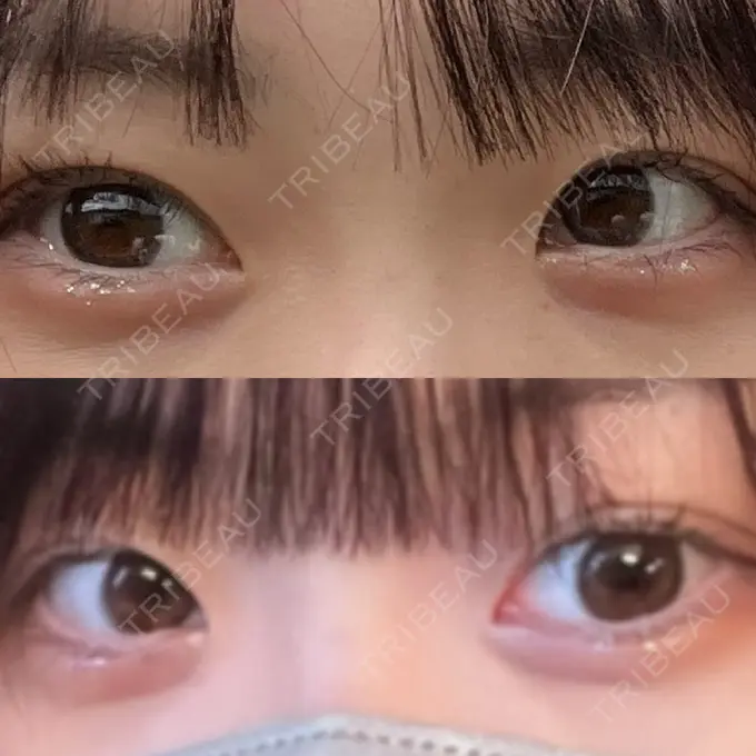 二重埋没 / 眼瞼下垂（非切開） WOM CLINIC GINZA （ワム クリニック ギンザ） BEFORE メイン用