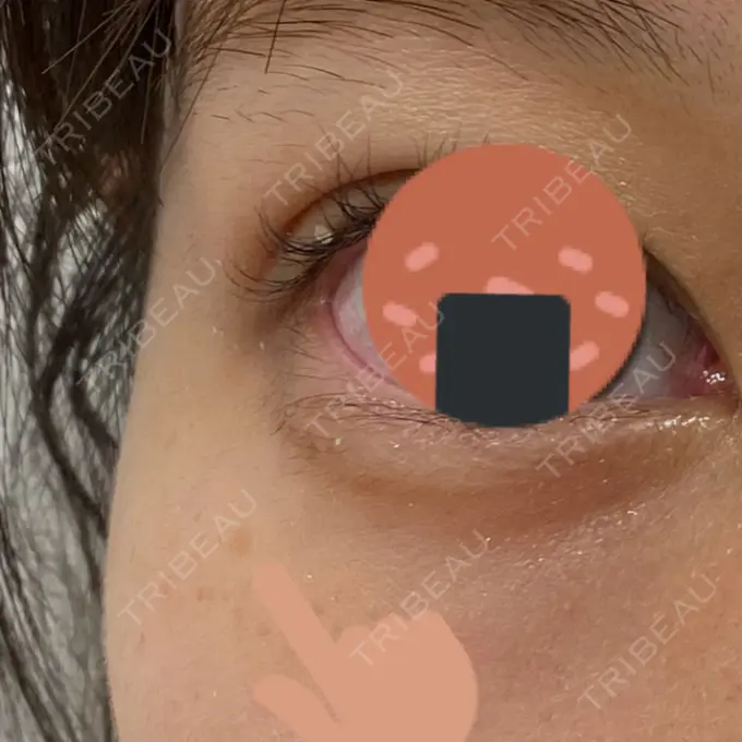 ピコスポット LOUIS CLINIC 二子玉川院【ルイクリニック】 BEFORE メイン用