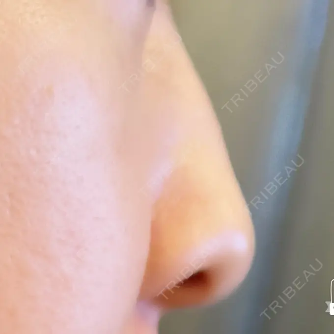 鼻尖形成（切開） / ワシ鼻修正・ハンプ切除 みずほクリニック BEFORE メイン用