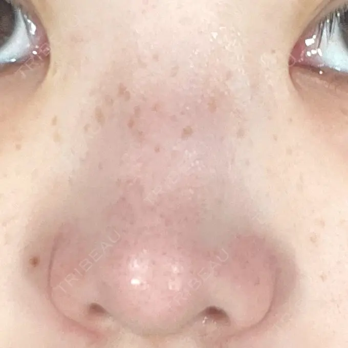 隆鼻術 / 鼻尖形成（切開） / 軟骨移植 / 鼻柱下降・鼻唇角形成（猫手術） グローバルビューティークリニック 大阪院 BEFORE メイン用