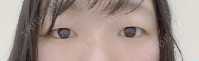 二重埋没 湘南美容クリニック 仙台院 BEFORE メイン用