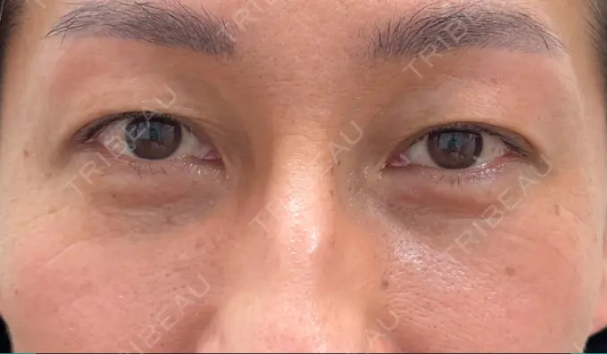 クマ治療 / シワ取りボトックス セオリークリニック BEFORE メイン用