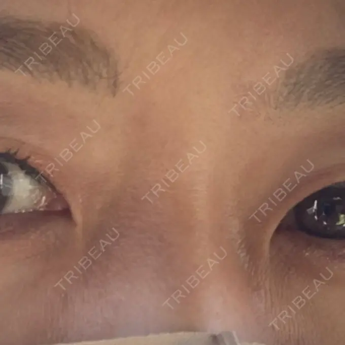 ボトックス（眉間） TCB東京中央美容外科 心斎橋院 BEFORE メイン用