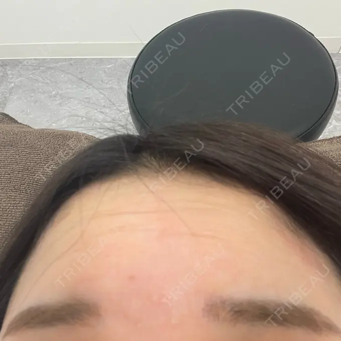 ボトックス（エラ・小顔） / ボトックス（額） TCB東京中央美容外科 仙台駅前院 BEFORE メイン用