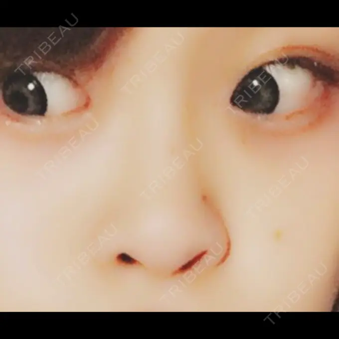 隆鼻術 湘南美容クリニック 柏院 BEFORE メイン用