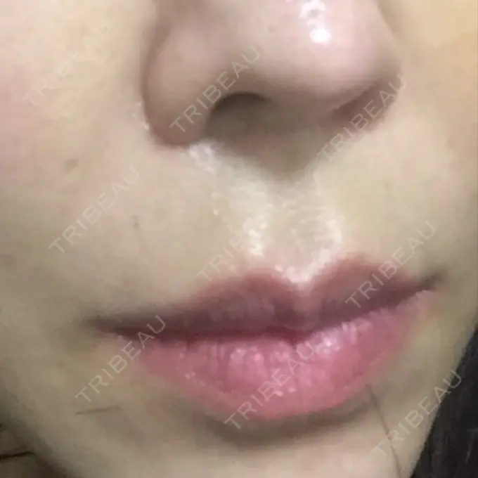 人中短縮 / 口唇縮小術 / 口角挙上 HB整形外科 BEFORE メイン用