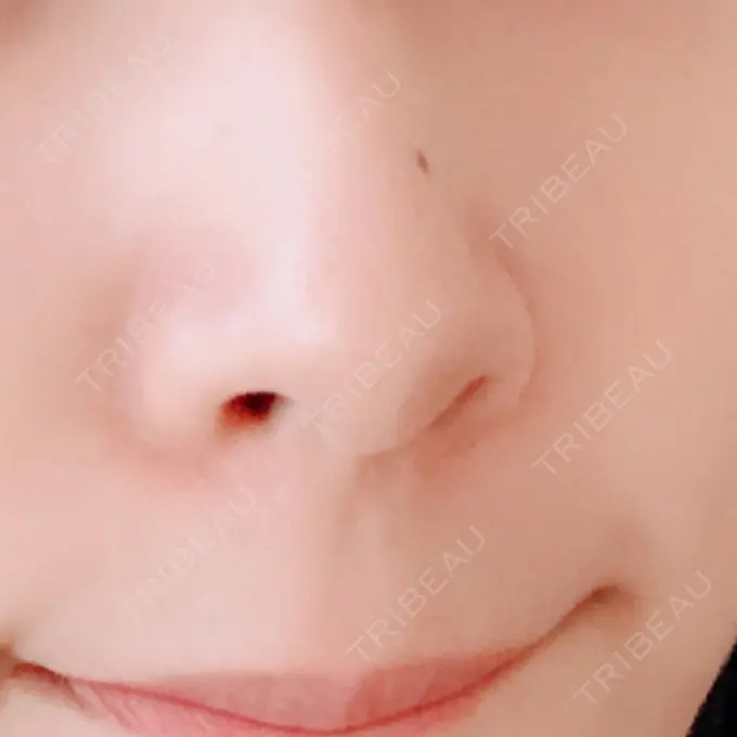 ほくろ・いぼ切除（肌） 吉祥寺アイビークリニック BEFORE メイン用