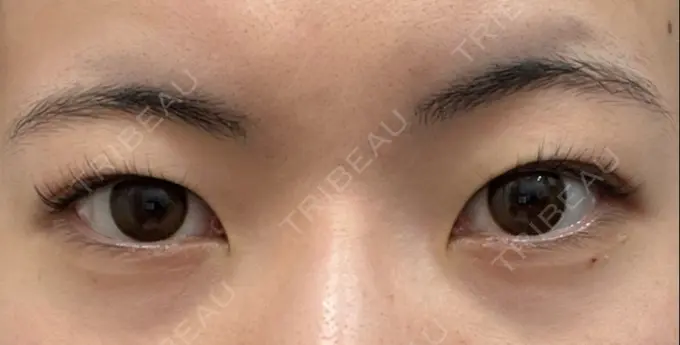 二重埋没 湘南美容クリニック 京都院 BEFORE メイン用