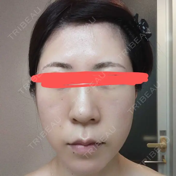 鼻尖形成（切開） / 軟骨移植 / 鼻柱下降・鼻唇角形成（猫手術） グローバルビューティークリニック 大阪院 BEFORE メイン用