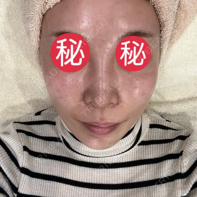 ピコレーザートーニング（美白・肝斑） / ピコスポット HAAB BEAUTY CLINIC 横浜院 BEFORE メイン用