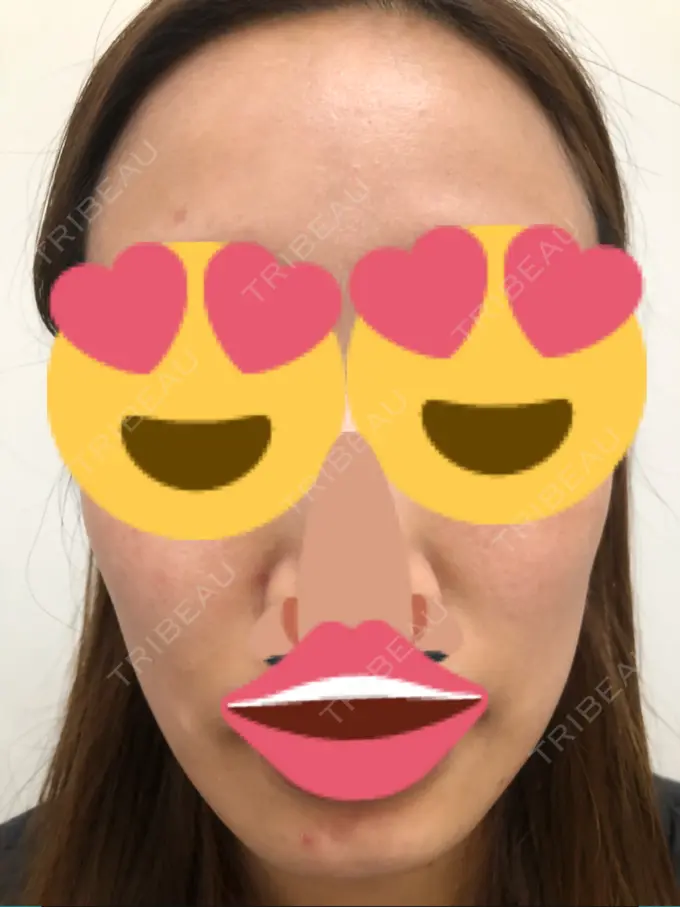 ニキビ治療 KM新宿クリニック BEFORE メイン用