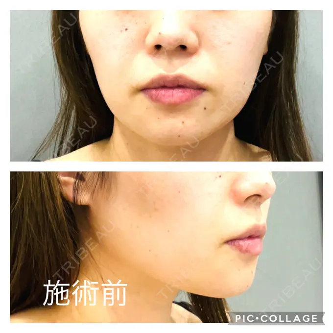 糸リフト アリエル美容クリニック 郡山院 BEFORE メイン用