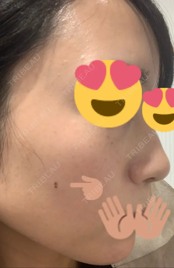 ほくろ・いぼ切除（肌） / 高濃度ビタミンC点滴 TCB東京中央美容外科 広島院 BEFORE メイン用