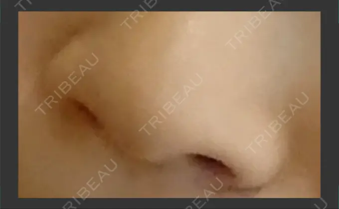 小鼻縮小（切開） 吉祥寺アイビークリニック BEFORE メイン用
