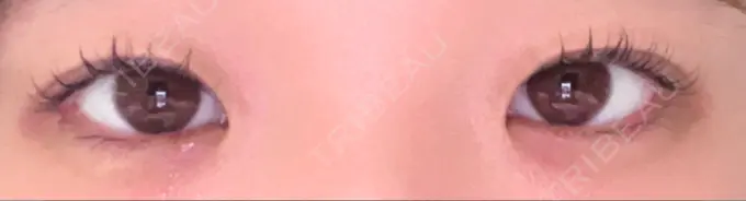 二重埋没 / 目頭切開 くさのたろうクリニック BEFORE メイン用