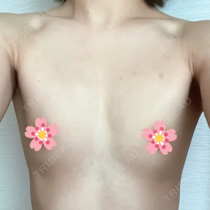 豊胸（脂肪注入） GAYA body design clinic BEFORE メイン用