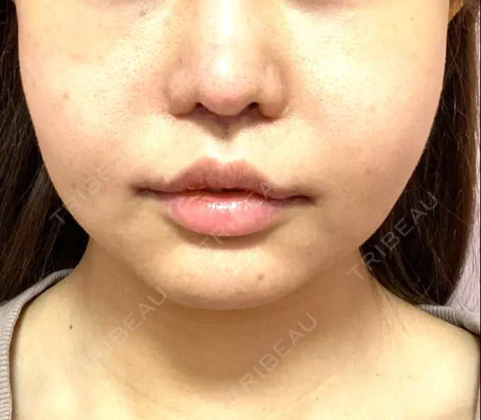 インディバ（お腹） / インディバ（二の腕） / インディバ（顔） / インディバ（腰） WOM SALON【術後ケア取扱いサロン】 BEFORE メイン用