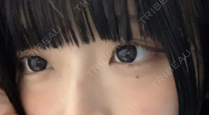 二重埋没 ルラ美容クリニック 名古屋本院 BEFORE メイン用