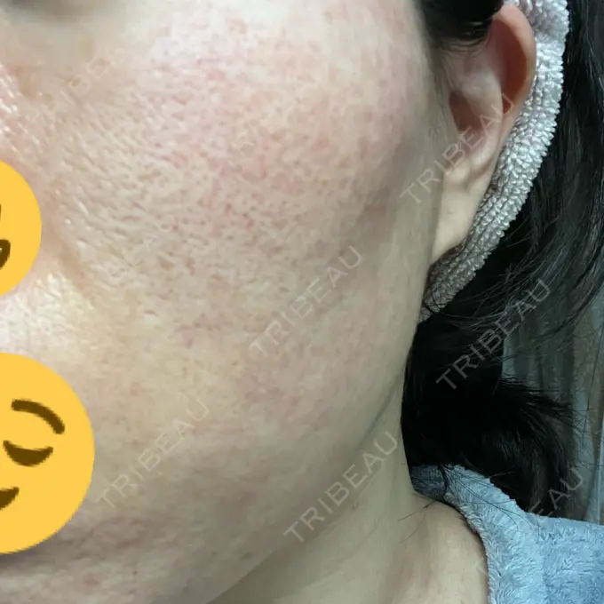 イオン導入 / ニードルRF（ポテンツァなど） オラクル美容皮膚科 名古屋院 BEFORE メイン用