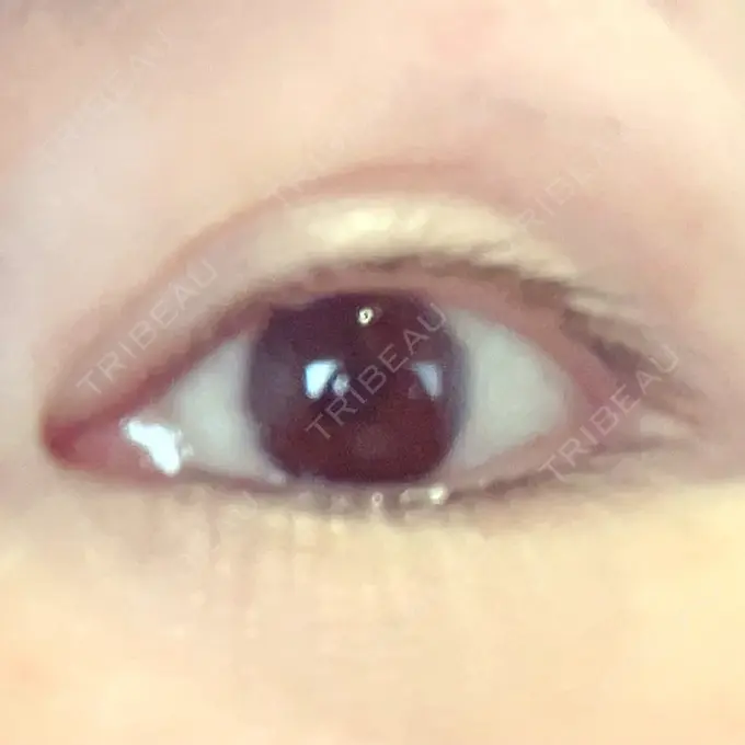 小鼻縮小（切開） / 眼瞼下垂（非切開） SOL CLINIC BEFORE メイン用