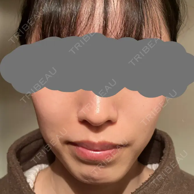 脂肪溶解注射（顔） SK新宿歌舞伎町美容外科・歯科 BEFORE メイン用