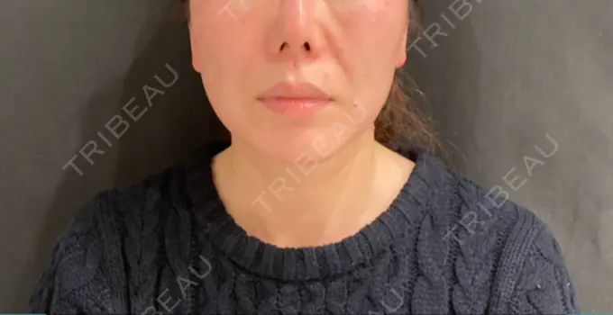 肌ヒアルロン酸注入（たるみ・シワ改善） / ボトックス（口角） / ボトックス（ガミースマイル） veary clinic BEFORE メイン用