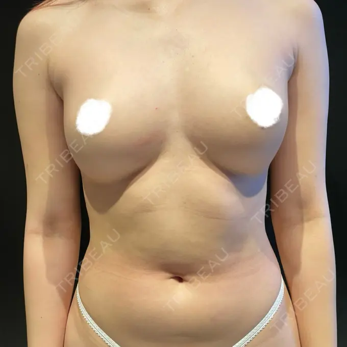 脂肪吸引（脚） / 脂肪吸引（お腹） / 脂肪吸引（お尻） / 豊胸（脂肪注入） / 脂肪吸引（腰） Casa de GRACIA GINZA 【カーサデグラシアギンザ】 BEFORE メイン用