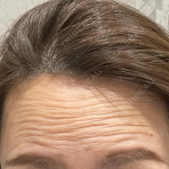 ボトックス（眉間） / ボトックス（額） X CLINIC 恵比寿院 BEFORE メイン用