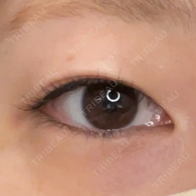 二重埋没 ネビュラクリニック 広島院 BEFORE メイン用