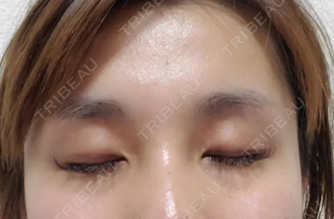 二重埋没 アリエル美容クリニック 郡山院 BEFORE メイン用