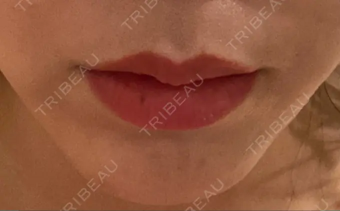 ボトックス（人中） veary clinic BEFORE メイン用