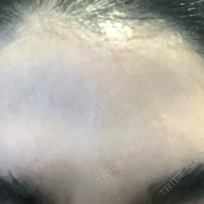 ダーマペン LIFIX BEAUTY CLINIC BEFORE メイン用