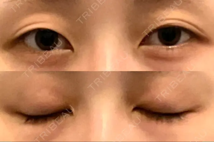 二重埋没 アリエル美容クリニック 郡山院 BEFORE メイン用