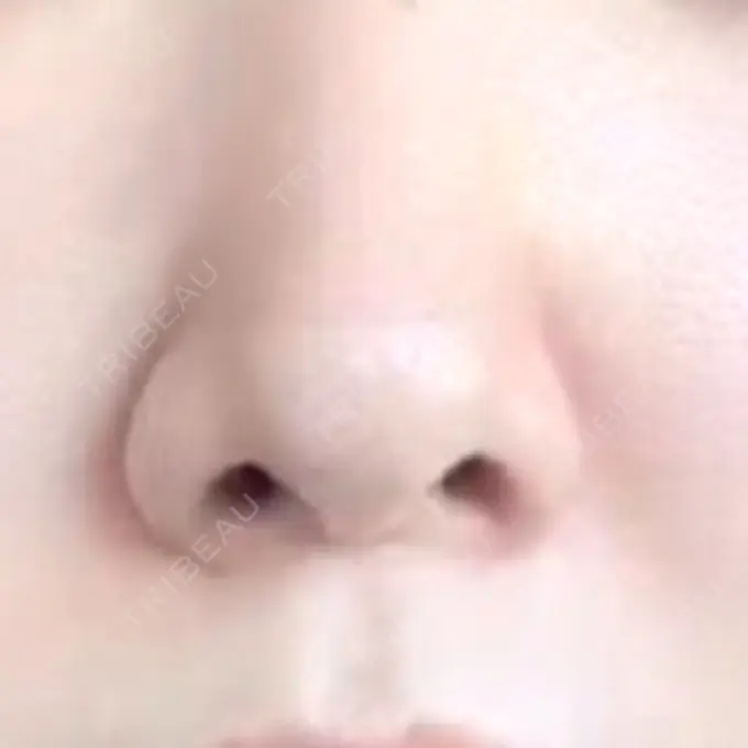 鼻尖形成（切開） / 鼻中隔延長（切開） / 鼻孔縁下降 / その他（目元） みずほクリニック BEFORE メイン用