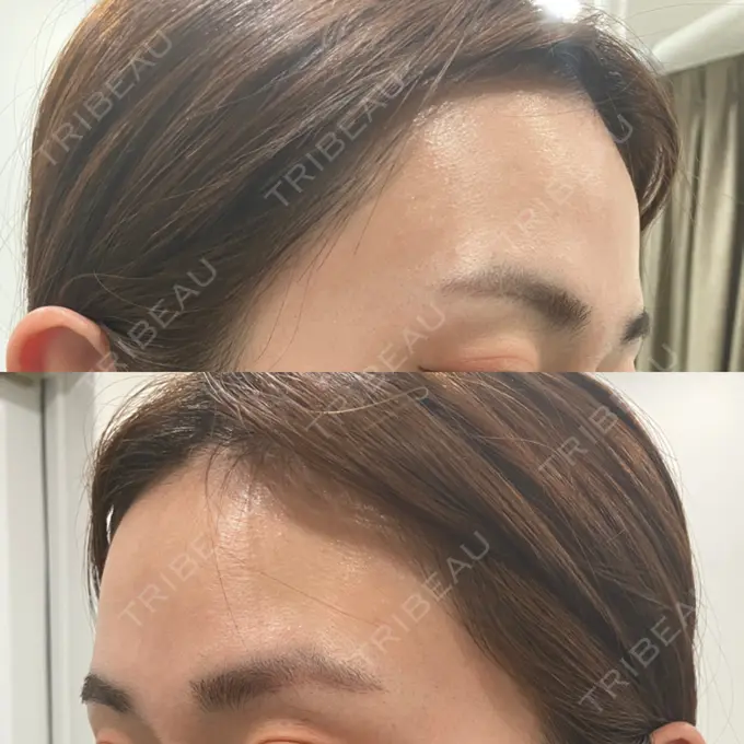 ヒアルロン酸注入（額） 吉井クリニック BEFORE メイン用