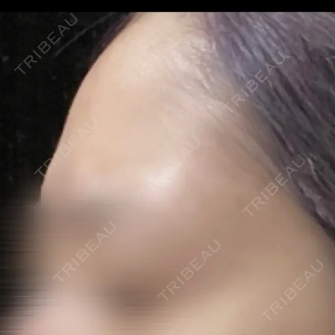 脂肪注入（額） / ヒアルロン酸注入（あご） X CLINIC 福岡天神院 BEFORE メイン用