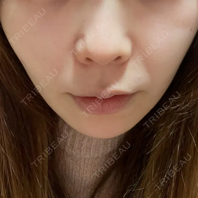 脂肪溶解注射（顔） アモーレクリニック 名古屋院 BEFORE メイン用