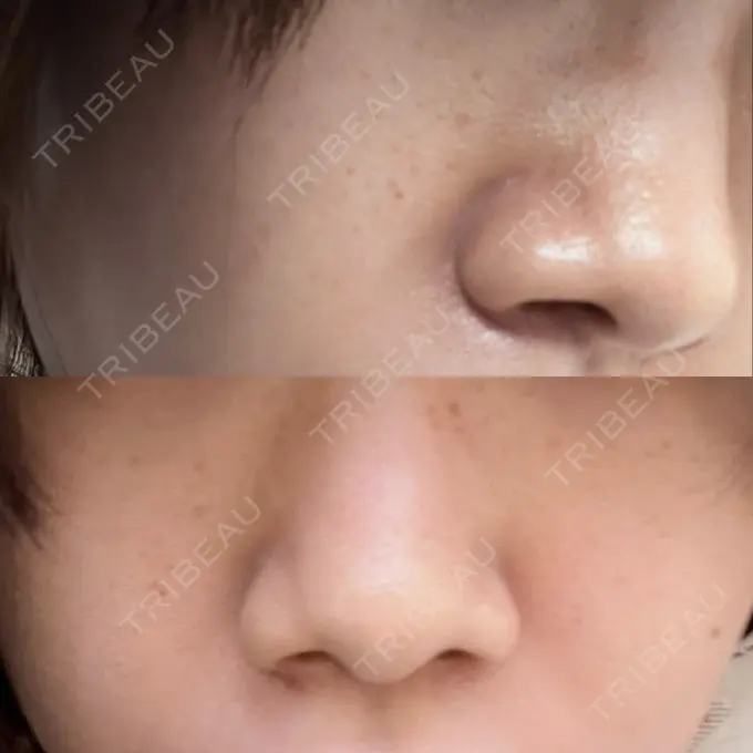 ピコレーザートーニング（美白・肝斑） / ピコフラクショナルレーザー（毛穴・ニキビ跡） ルラ美容クリニック 高田馬場院 BEFORE メイン用