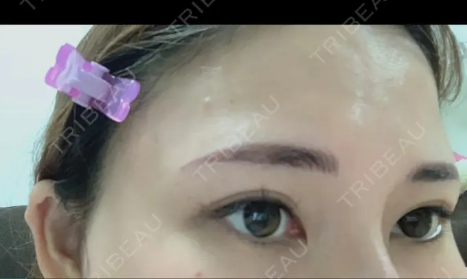 ヒアルロン酸注入（涙袋） 渋谷美容外科クリニック 渋谷院 BEFORE メイン用