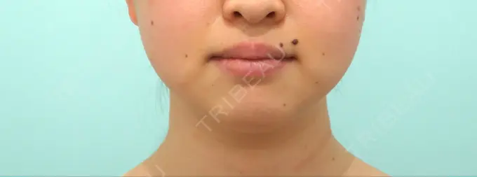 脂肪吸引（顔） / 下まぶたの脂肪取り / 脂肪注入（目の下） / ボトックス（エラ・小顔） WOM CLINIC GINZA （ワム クリニック ギンザ） BEFORE メイン用