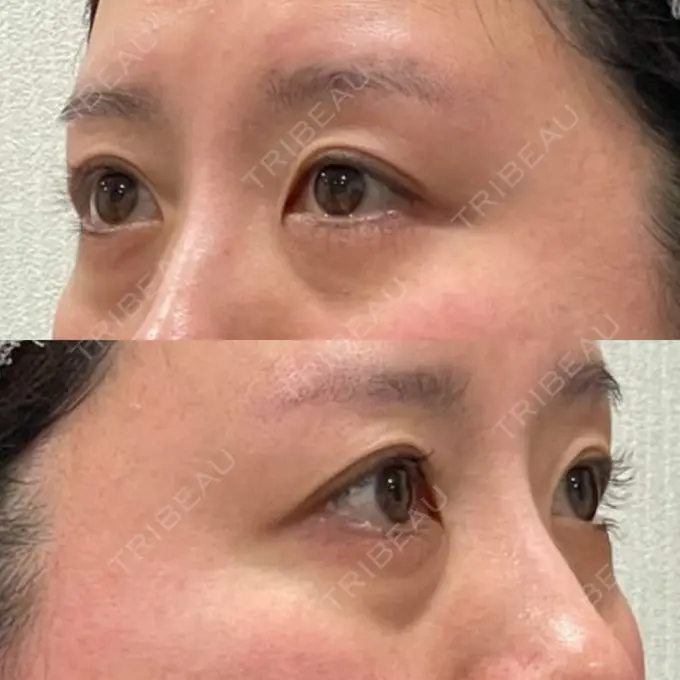 下まぶたの脂肪取り / その他（輪郭） 吉井クリニック BEFORE メイン用